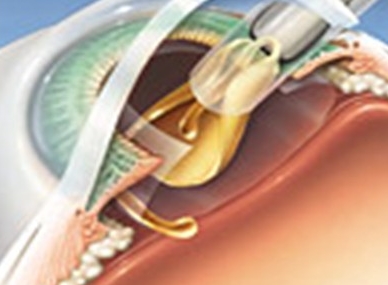 眼科白内障手术