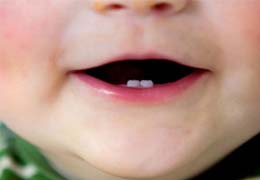 才出生的宝宝带着两颗下门牙来昆明同仁口腔科求诊